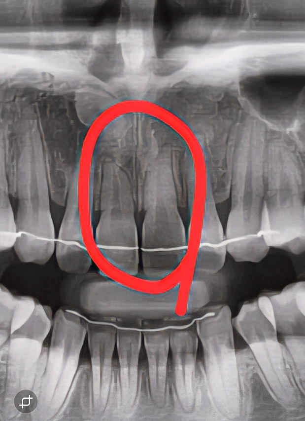 What Is Root Resorption? Changes in the Front Tooth Roots That Can Occur During Orthodontic Treatment image 4