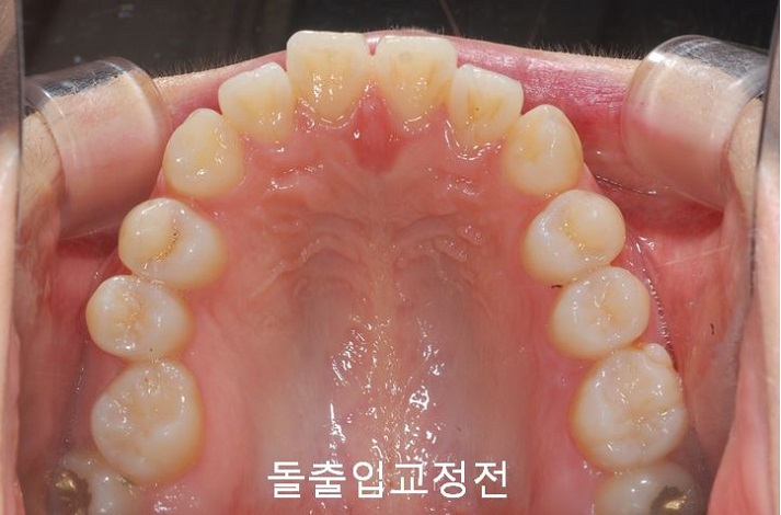 치아교정) 유지장치는 평생 해야 한다? 관련 이미지 2