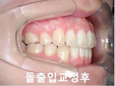 돌출입교정에 성공하는 방법 3가지! 관련 이미지 9