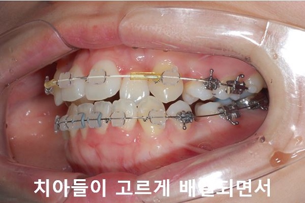 덧니교정 조심할것 3가지 관련 이미지 10