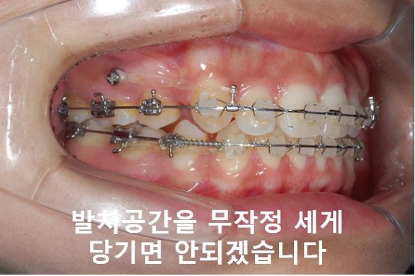 대학생 돌출입교정 망하지 않는 법! 관련 이미지 6