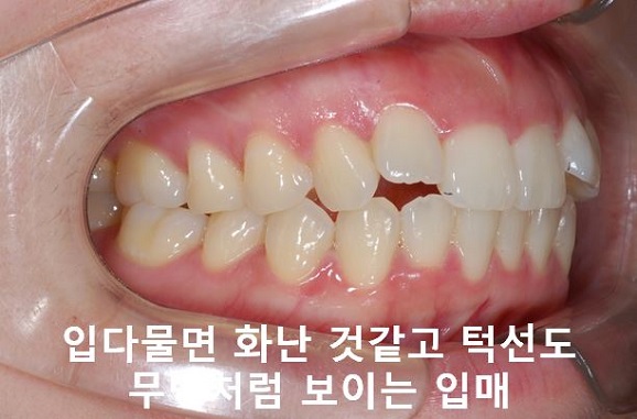 덧니교정이 곧 입매교정! 관련 이미지 13