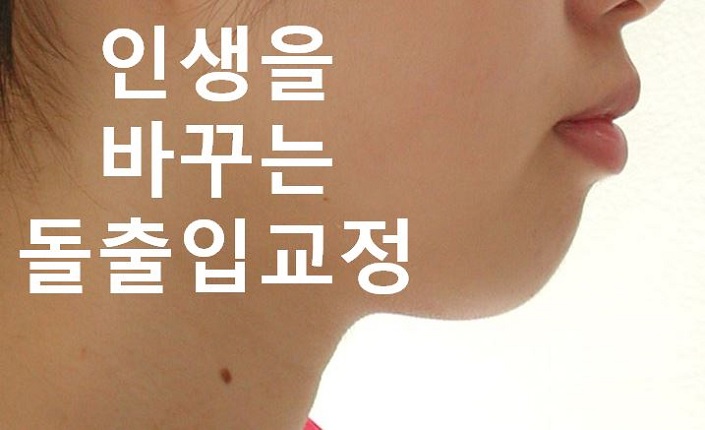 돌출입교정의 효과적인 시기! 관련 이미지 9