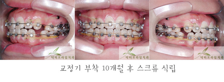 [치아교정후기] 30대 돌출입교정전후와 후기 관련 이미지 3