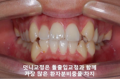 덧니교정과정, 4가지 요점만 알고 시작하세요! 관련 이미지 2
