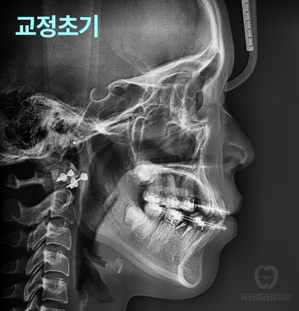 강남역 교정치과, 돌출입 발치교정하면 합죽해진다? 그렇습니다. 사실입니다 관련 이미지 12