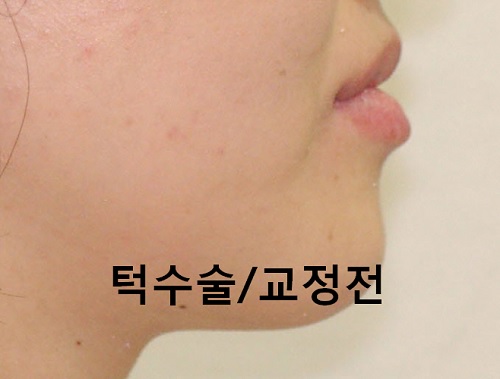 덧니와 주걱턱이 같이 있는 경우에 가장 효과적인 교정방법! 관련 이미지 14