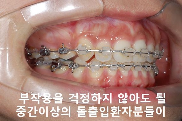 대학생 돌출입교정 망하지 않는 법! 관련 이미지 7