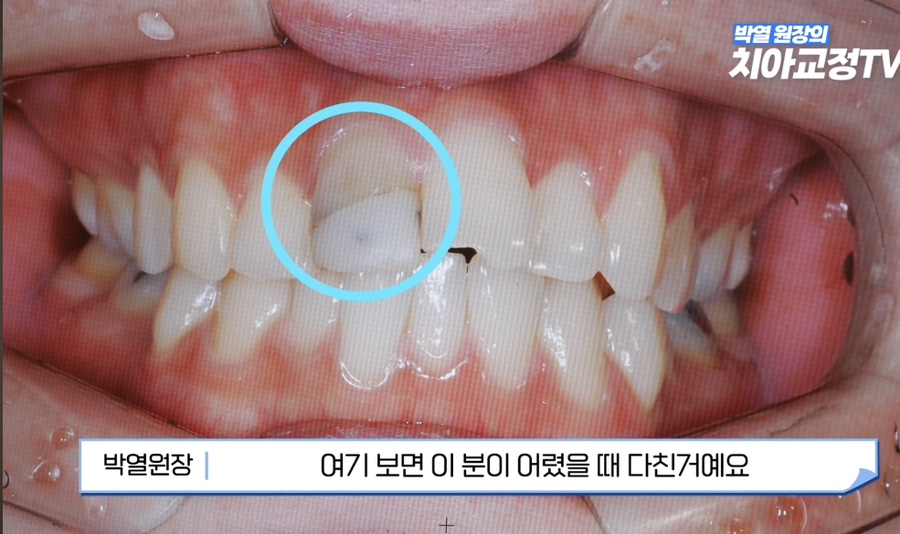 강남역치아교정, 신경치료 받은 치아도 교정이 될까? 관련 이미지 13
