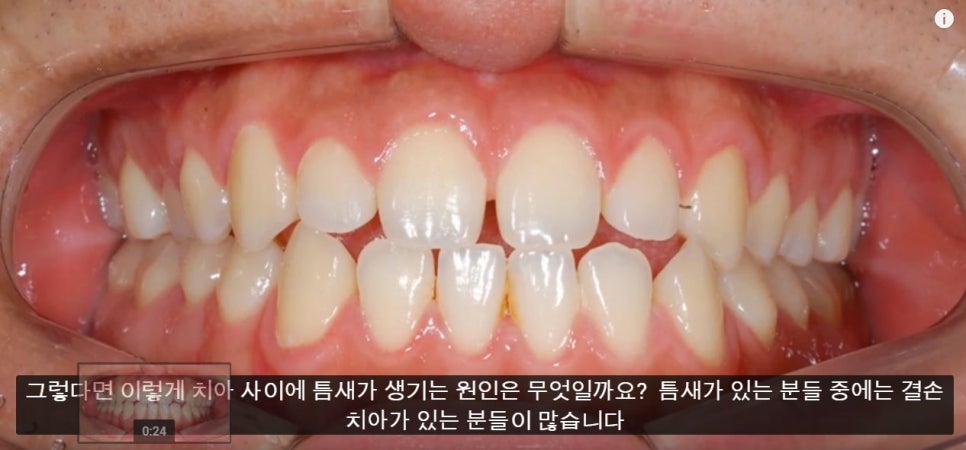 [치아교정] 치아사이에 틈새가 있는 부정교합(레진이나 라미네이트말고 치아교정으로 틈새닫기) 관련 이미지 3