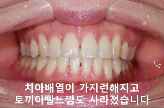 덧니교정이 곧 입매교정! 관련 이미지 8