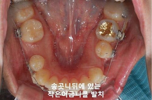덧니교정과정, 4가지 요점만 알고 시작하세요! 관련 이미지 12
