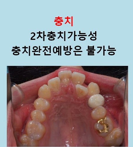 교정만으로 개선가능한 안면비대칭 알아보기(닥터프라임치과) 관련 이미지 6