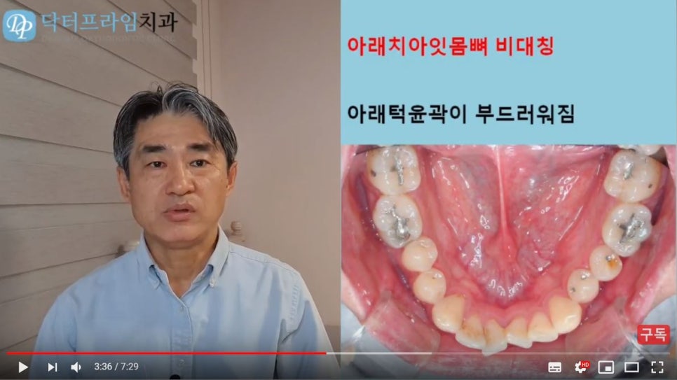 얼굴이 이뻐지는 치아교정! (덧니, 비대칭, 돌출입) 관련 이미지 7