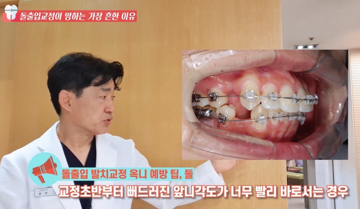 돌출입 교정치과 옥니 돌출입 치아 교정 왜 망할까? 관련 이미지 18