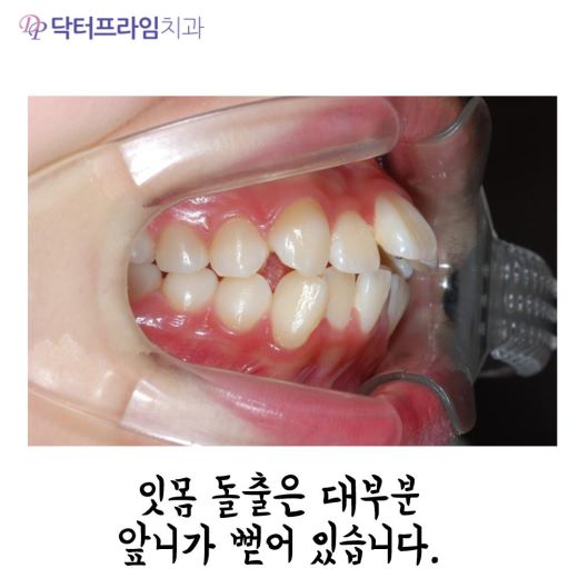잇몸돌출교정 방법, 사진으로 보는 교정 방법! 관련 이미지 2