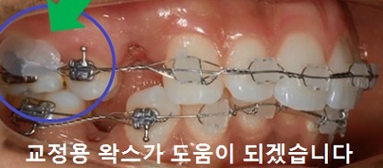 교정시작을 망설이게 하는 치아교정통증(2) 관련 이미지 5