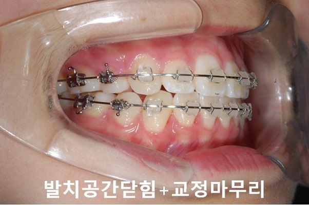 튀어나온입 교정과정 4단계요약 관련 이미지 7
