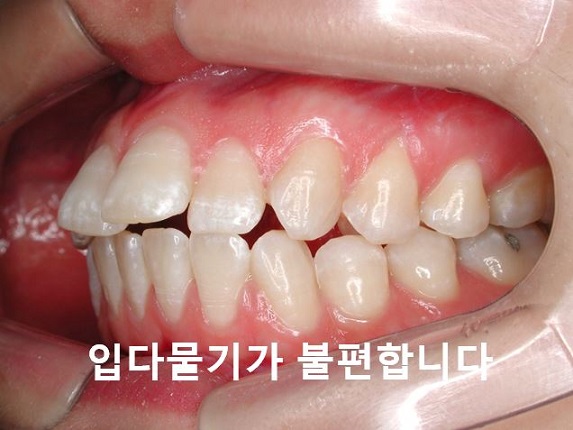 돌출입교정의 효과적인 시기! 관련 이미지 4