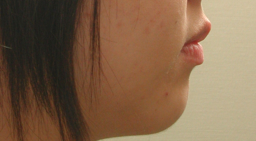 앞니덧니교정사례 관련 이미지 10