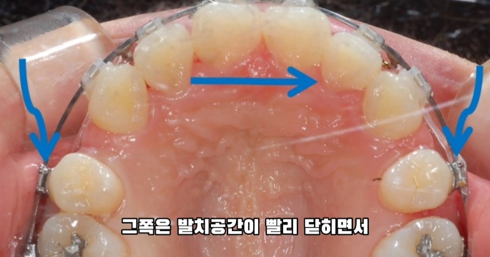 돌출입 교정 하실 분, 이것만은 꼭 알고 시작해야 합니다! 관련 이미지 7