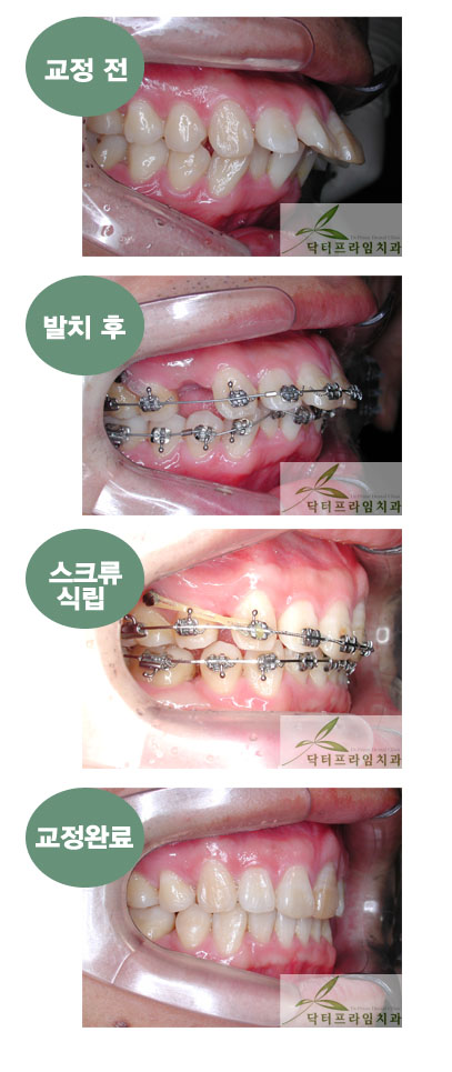 [치아교정후기] 돌출입교정전후.교정스크류를 사용하면 심한 돌출입도 성공치료가능해요!~~ 관련 이미지 1