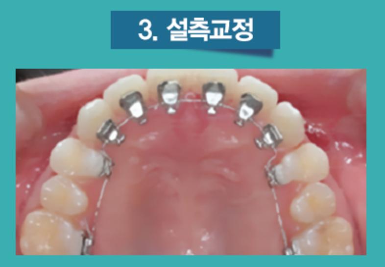 치아교정의 종류 4가지 1) 세라믹교정 2) 클리피시교정 3)설측교정 4) 투명교정 관련 이미지 3