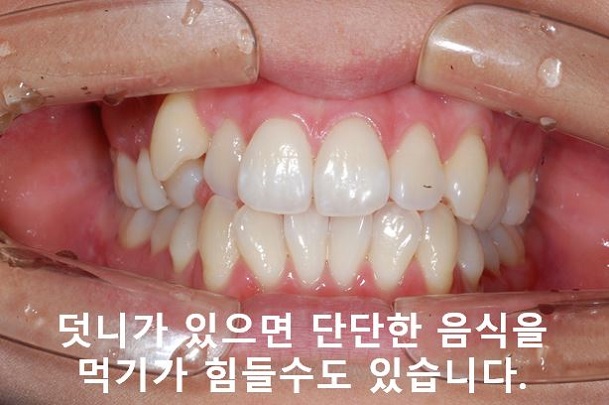 청소년, 덧니교정 안하면 이렇게 된다! 관련 이미지 9