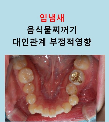 교정만으로 개선가능한 안면비대칭 알아보기(닥터프라임치과) 관련 이미지 7