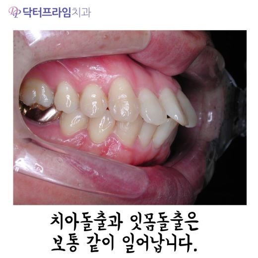 잇몸돌출교정 방법, 사진으로 보는 교정 방법! 관련 이미지 1