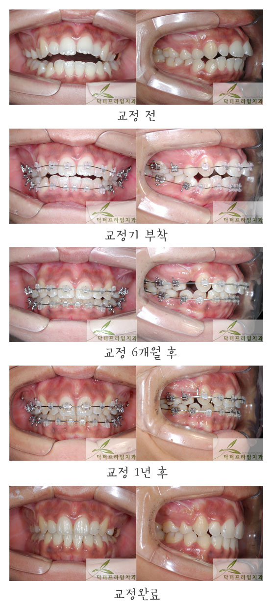 [치아교정후기] 돌출입+개방교합+무턱.  발음이 새고 둔해보여요 ㅠㅠ 관련 이미지 1
