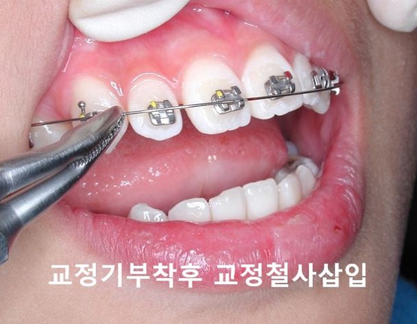 [교정기부착] 돌출입교정할때 교정기부착하는 법! 관련 이미지 8