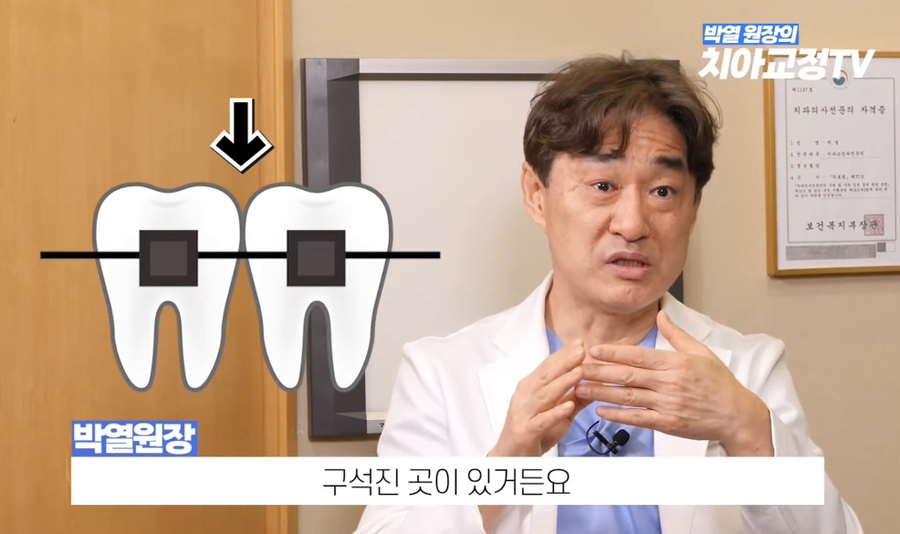 Brace Pain Tylenol: Why Does It Hurt So Much for 3 Days After Getting Braces? A Complete Guide to Causes and How to Cope image 8