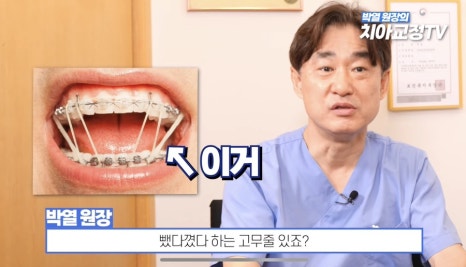 Worried About Orthodontic Pain? The Most Painful Moments During Orthodontic Treatment: Top 7 Pain Ranking image 4