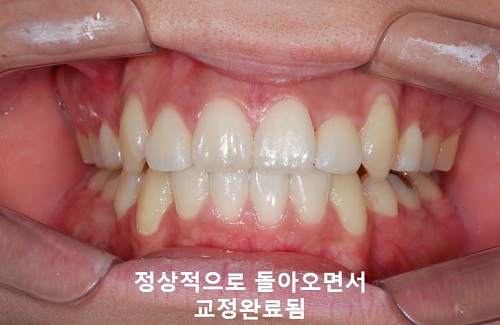 덧니교정과정, 4가지 요점만 알고 시작하세요! 관련 이미지 19