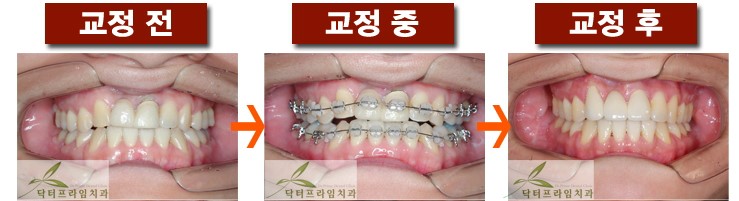 [치아교정후기] 앞니크라운 있는 경우의 치아교정전후 관련 이미지 1