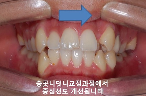 덧니교정과정, 4가지 요점만 알고 시작하세요! 관련 이미지 16