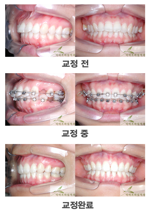 [치아교정후기] 치아는 가지런한데, 입이 돌출이예요!  발치해야 하나요? 관련 이미지 1