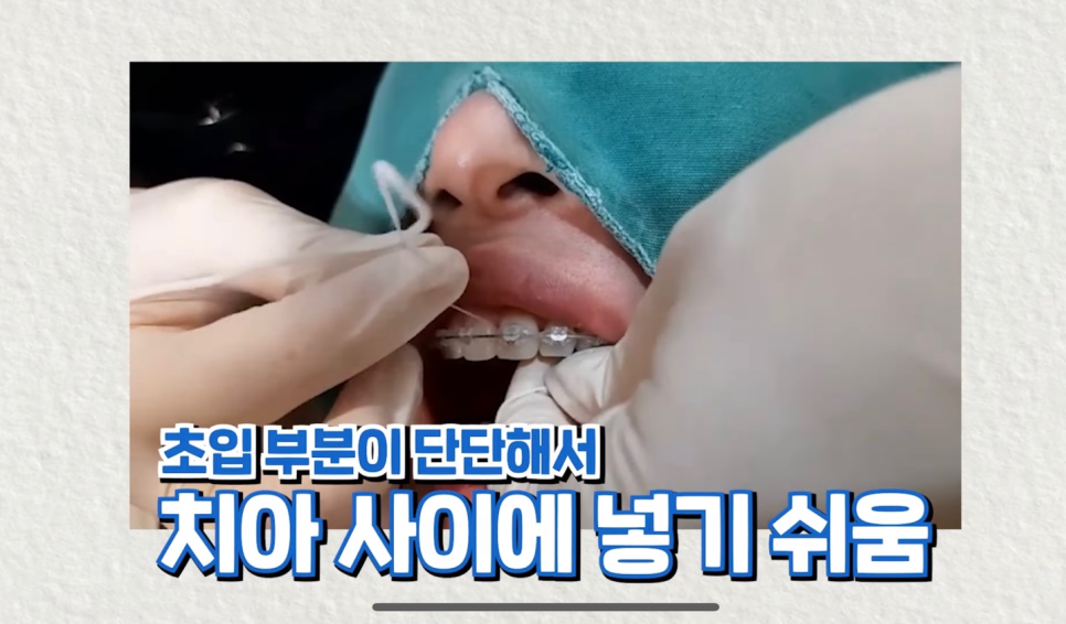 교정기 치아 교정 음식물 끼임 어떻게 해결해야할까? 관련 이미지 9