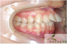 [돌출입교정] 10대 돌출입교정전후 관련 이미지 1