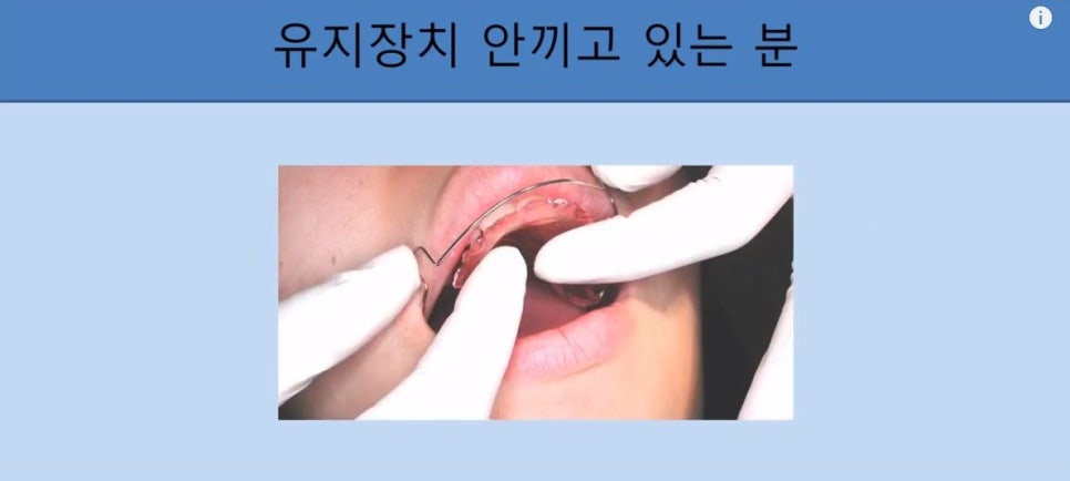 [치아교정] 치아교정 끝나고 요새 유지장치 안끼시는 분들 꼭 보시고 새출발하세요~~!! (돌출입교정, 덧니교정, 양악수술교정, 앞니교정한 분들 모두 해당됩니다) 관련 이미지 8