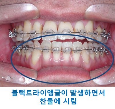 교정시작을 망설이게 하는 치아교정통증(1) 관련 이미지 15