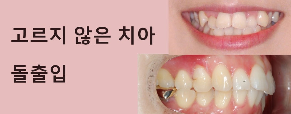 교정발치에 대하여 관련 이미지 1