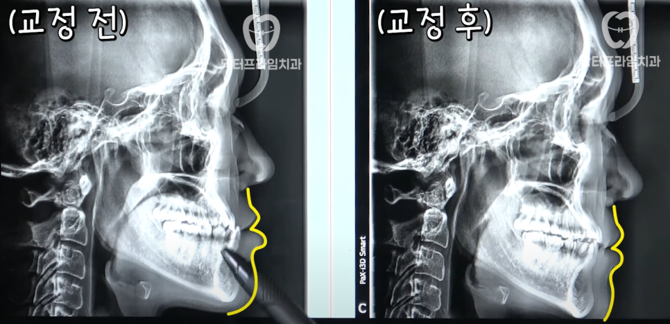 강남역 치아교정 추천/ 튀어나온 아래턱, 양악수술 대신 교정으로 해결할 수 있는 경우 관련 이미지 1