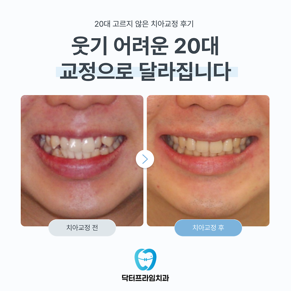 웃기 어려운 20대, 교정으로 달라집니다. 관련 이미지 1