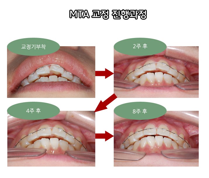 [앞니부분교정] 3개월~6개월 관련 이미지 2