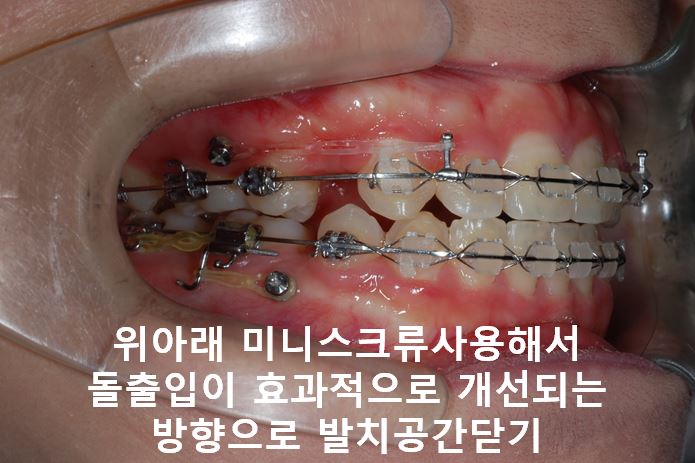 강남역돌출입교정, 옥니방지비법!! 관련 이미지 5