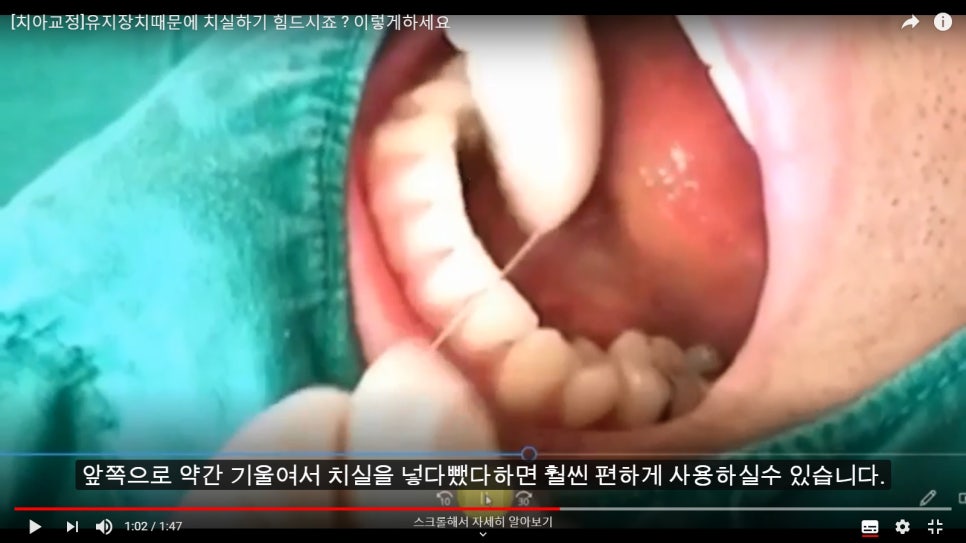 [치아교정] 고정식유지장치하고 있는 분들 보세요. 치실사용법 알려드려요!! 관련 이미지 2
