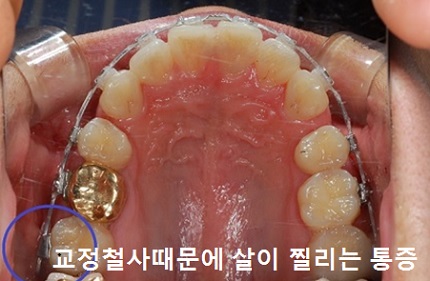 교정시작을 망설이게 하는 치아교정통증(2) 관련 이미지 4