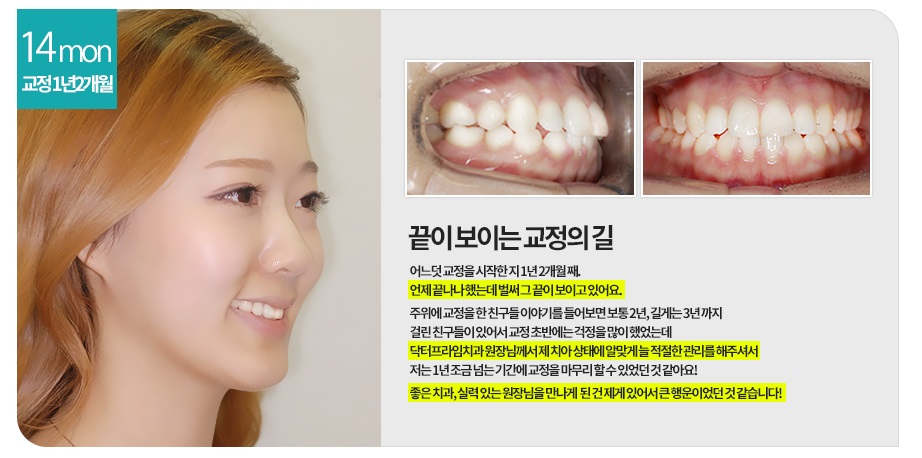 [돌출입교정전후] 앞니돌출교정사례 관련 이미지 5
